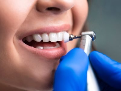 beneficios-limpieza-dental-1021x640