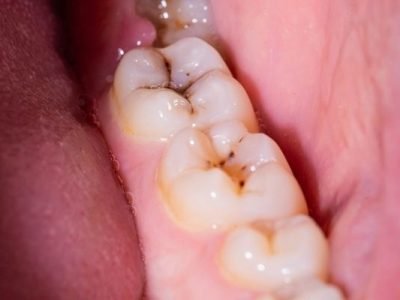 tratamiento-de-la-caries-dental